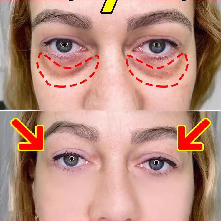 Puffy Peepers Fix