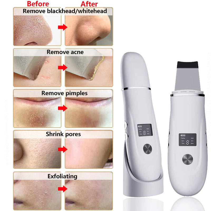 Ultrasonic Face Scrubber Kit