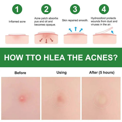 Hydrocolloid Pimple Patches