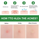 Hydrocolloid Pimple Patches
