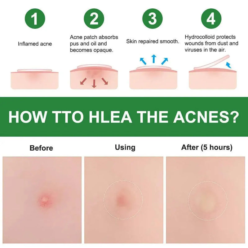 Hydrocolloid Pimple Patches