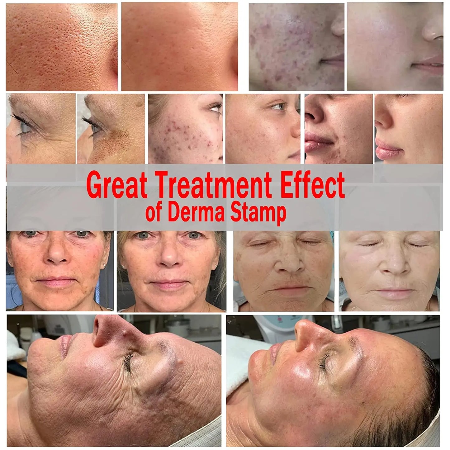 Adjustable Derma Stamp