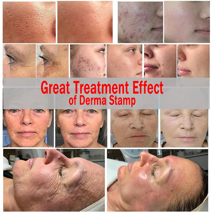 Adjustable Derma Stamp