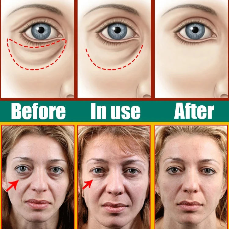 Puffy Peepers Fix