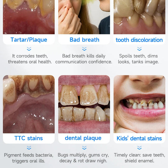TartarCam Teeth Cleaner Kit